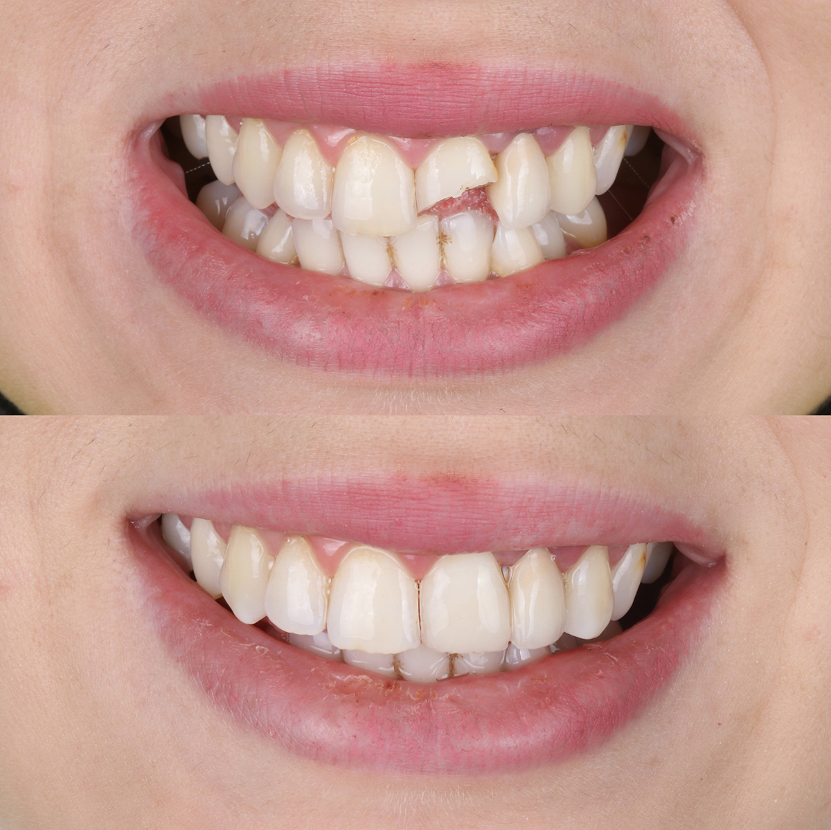 Ceramic Dental Crowns near Modesto