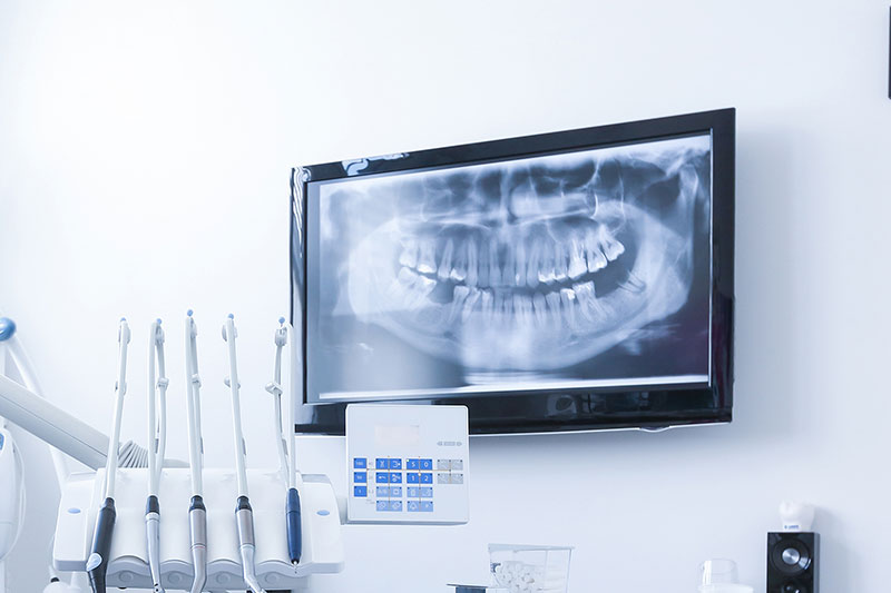 Ceramic Dental Crowns near Modesto