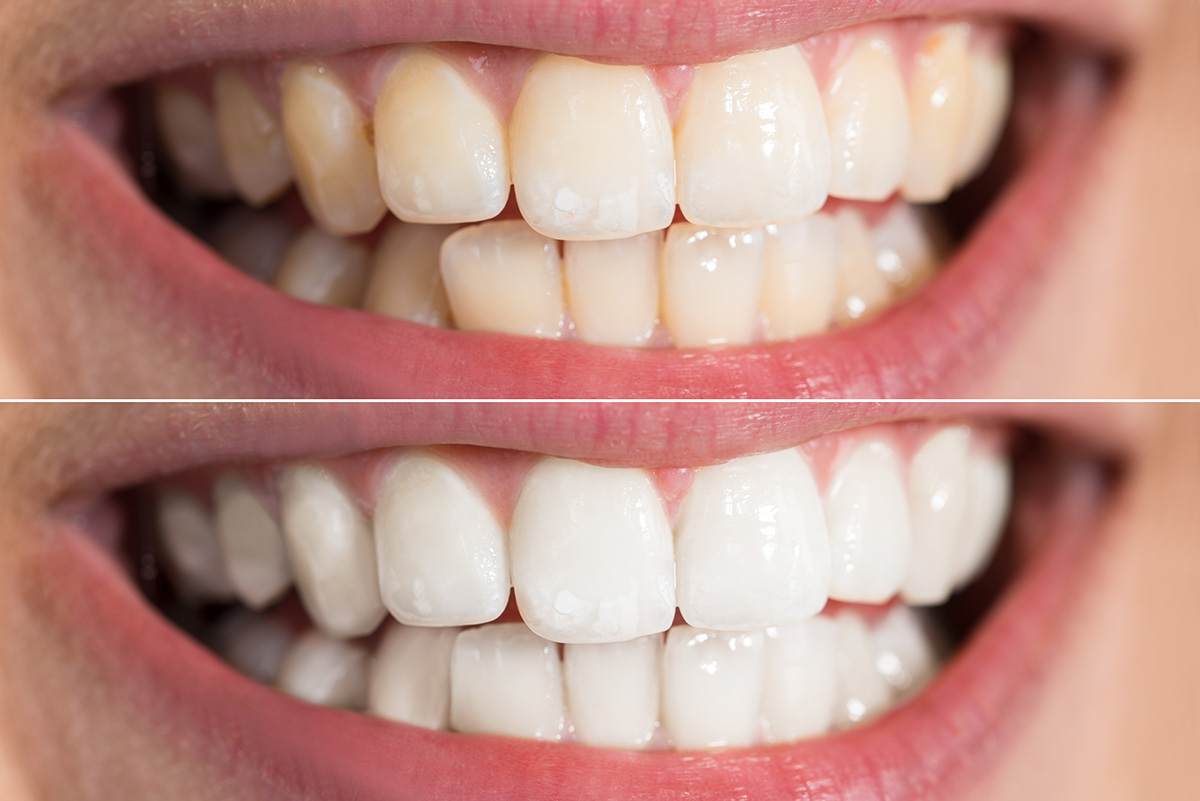Ceramic Dental Crowns near Modesto