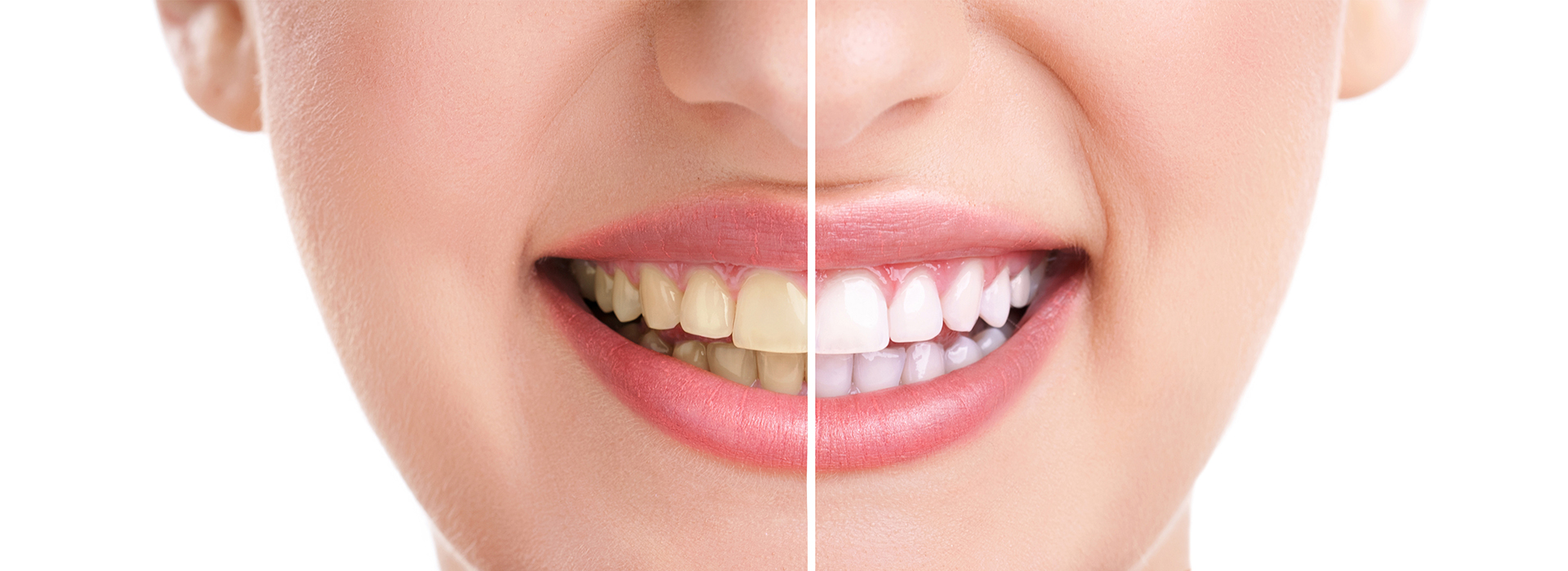 Wayne T. Yee, DDS | Extractions, Night Guards and Teeth Whitening
