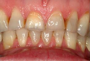 Wayne T. Yee, DDS | Veneers, Implant-Supported Dentures and Preventative Program